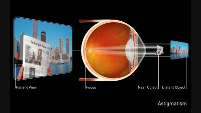 Astigmatism-Graphic-with-Astigmatism-Eye-and-patient-view