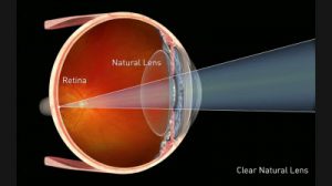 Clear Natural Lens