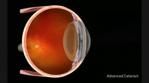 Natural Lens with Cataract