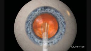 IOL Unfolding Inside Eye