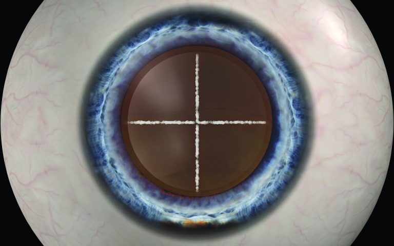 femto-cataract-Hi-Res-Images_lasercross-768x480