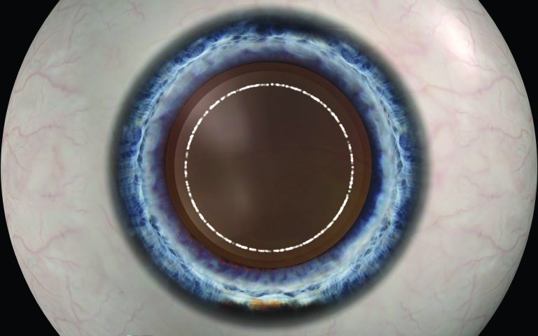 femto-cataract-Hi-Res-Images_laserrhexis-768x480